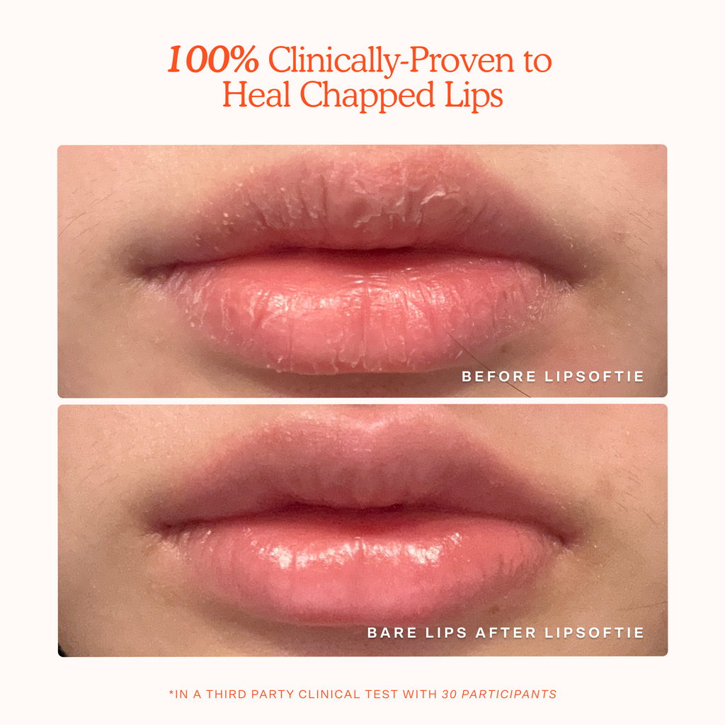 LipSoftie® Lip Treatment G1