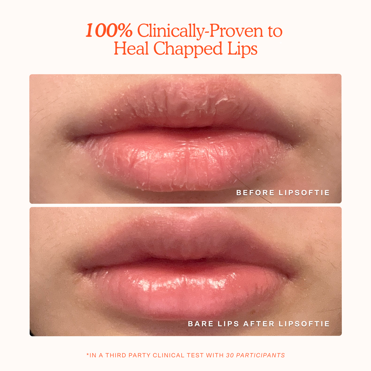 LipSoftie® Lip Treatment G1