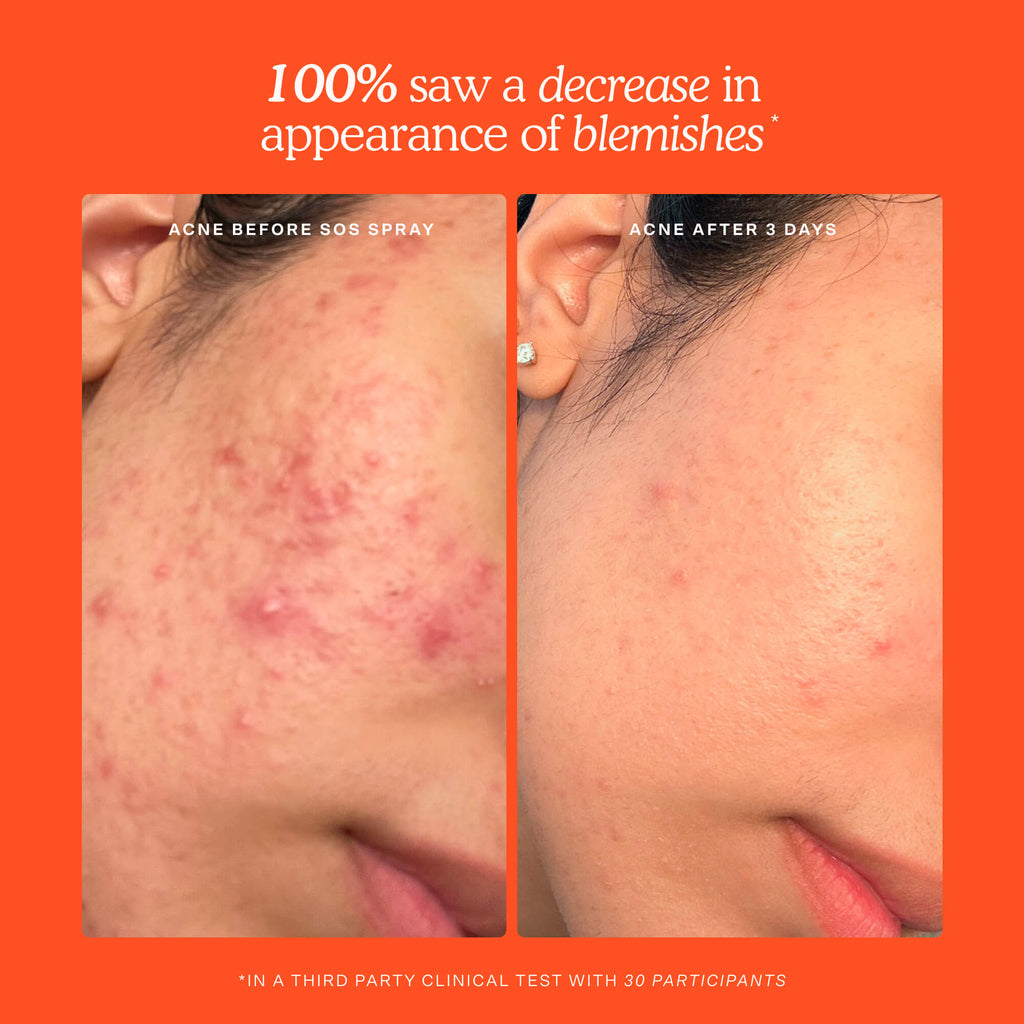 SOS Skincare Minis Kit S2
