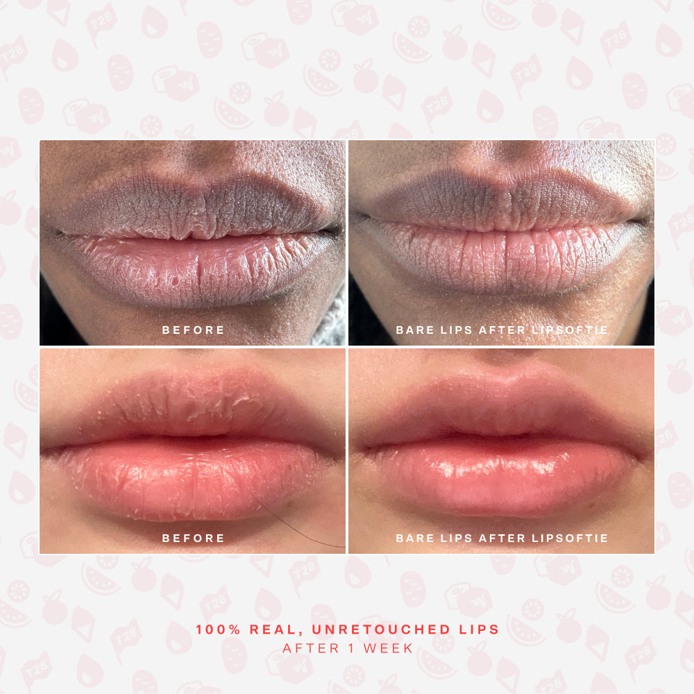 SOS LipSoftie® Lip Treatment O8