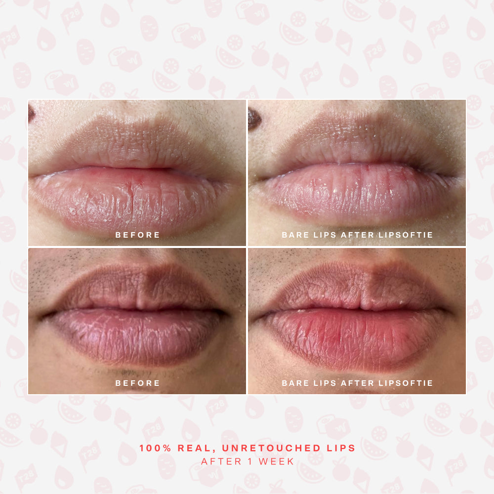 LipSoftie® Lip Treatment G1